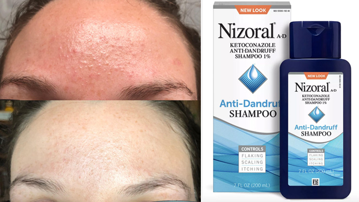 Dandruff Shampoo Face Mask