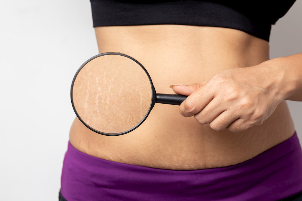 stretch marks treatment_22bdebeb ee3b 4dd9 918e 6e6de8cda18b