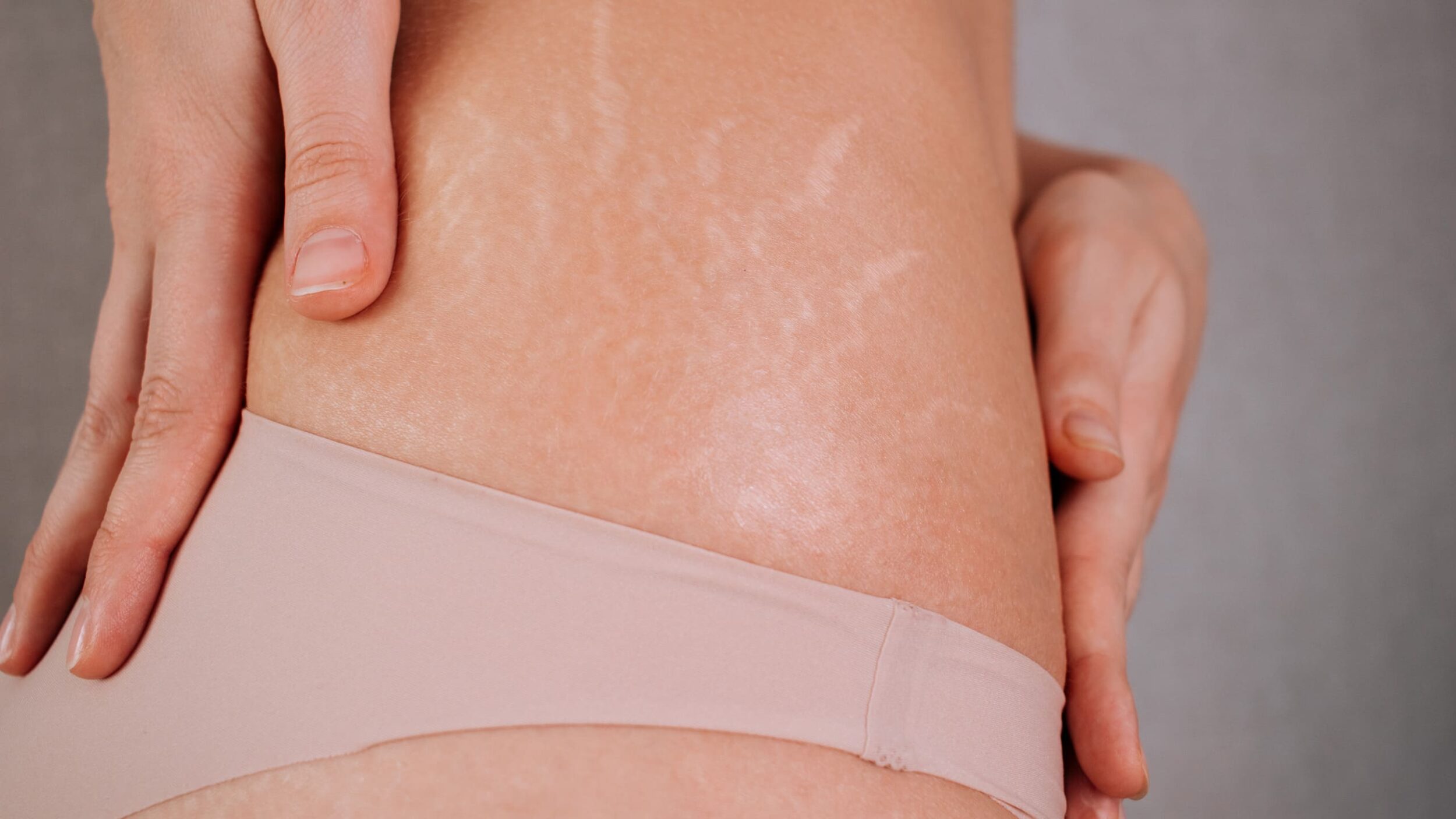 stretch marks treatment_cc5322b2 4b2c 4941 bed0 38790677c12a