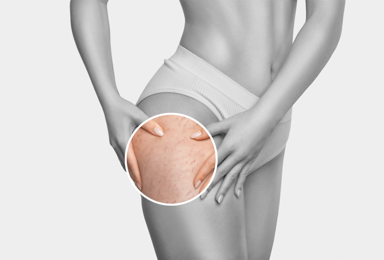 stretch marks treatment_dc6b66c9 d850 4d19 9925 ec1935351e4b